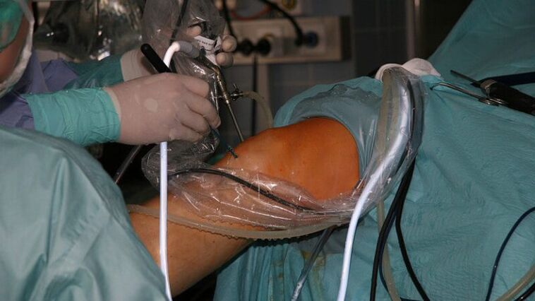 chirurgiczne leczenie artrozy