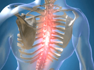 Nawracający lub uporczywy ból w osteochondrozie w klatce piersiowej