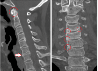 Tomografia komputerowa pokazuje uszkodzone kręgi i dyski o niejednorodnej wysokości z powodu osteochondrozy klatki piersiowej