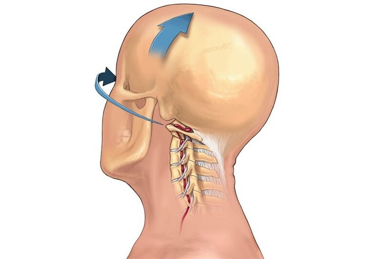 chrupnięcie szyi podczas obracania głowy jako objaw osteochondrozy szyjnej