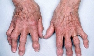 jak odróżnić zapalenie stawów palców od artrozy