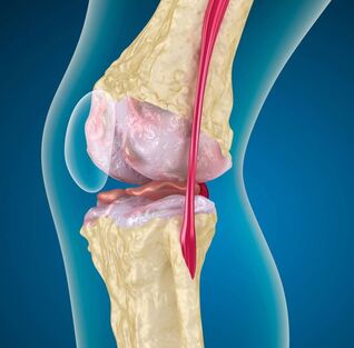Artroza kolana